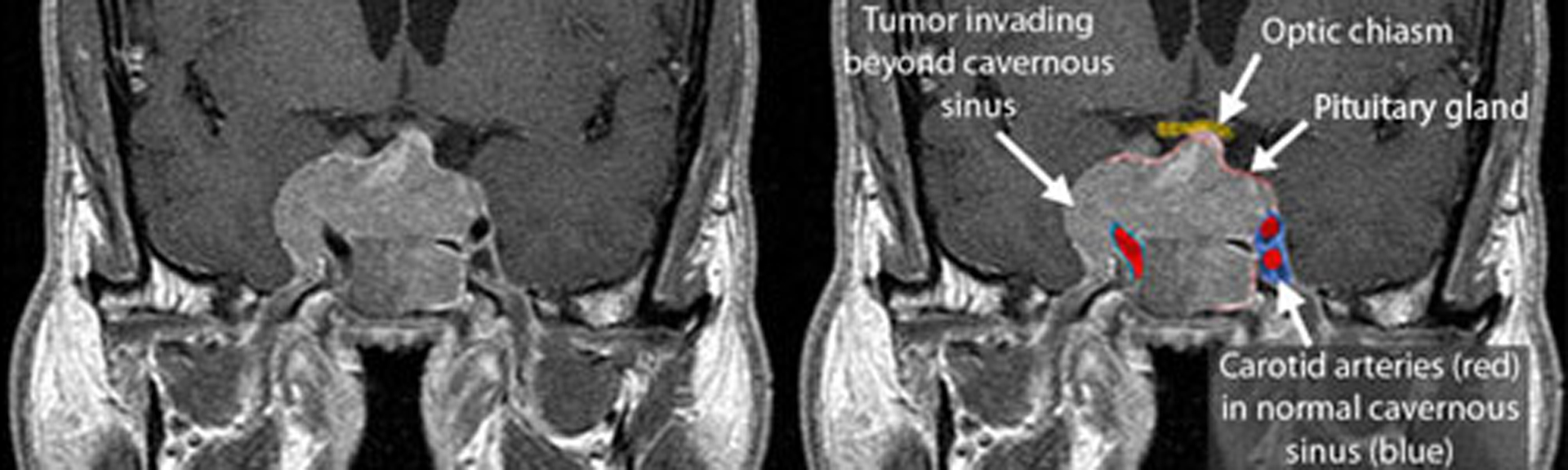 adenomas