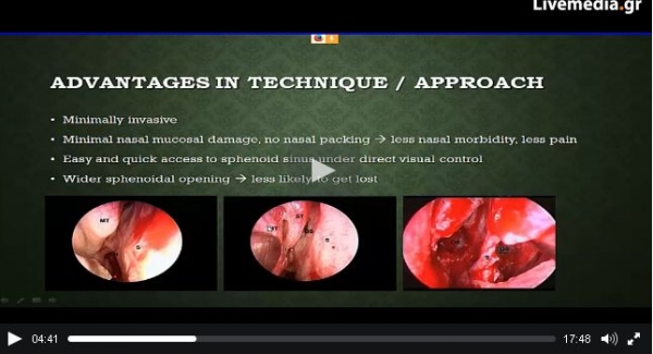 Endoscopic endonasal pituitary surgery: does it make a difference? by Mr Nick Paidakakos