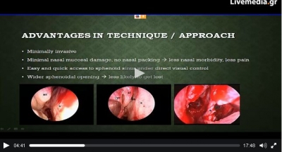 Endoscopic endonasal pituitary surgery: does it make a difference? by Mr Nick Paidakakos